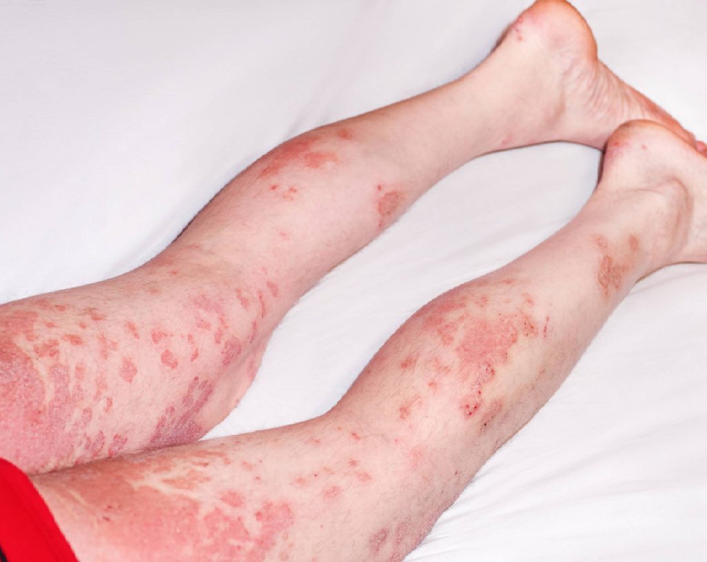 Piernas de niño acostado que muestran en la piel lesiones rojas propias de la infección por escarlatina.