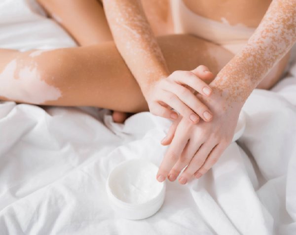 ¿Que es el vitiligo y como se trata?