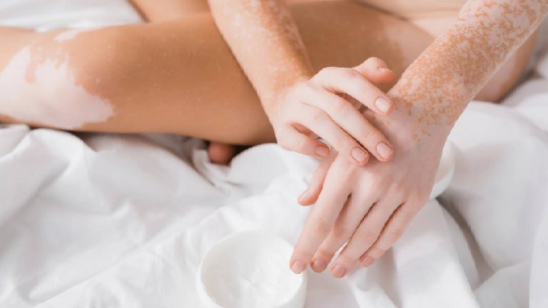 Vitiligo: causas y tratamiento | Hospital Angeles
