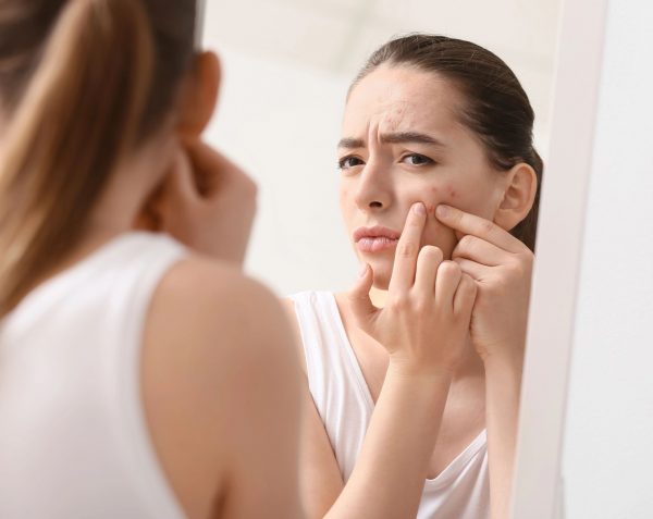 Acné hormonal | Causas en mujeres y hombres
