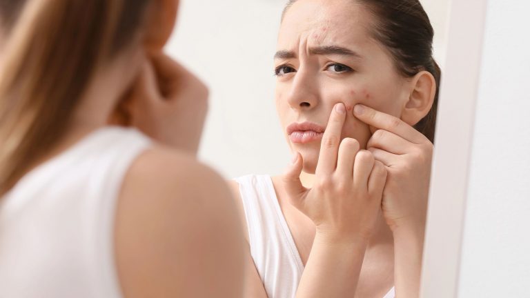 Acné hormonal | Causas en mujeres y hombres