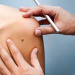Médico examina el brazo de un paciente para evaluar un bulto sospechoso de carcinoma basocelular o basalioma.