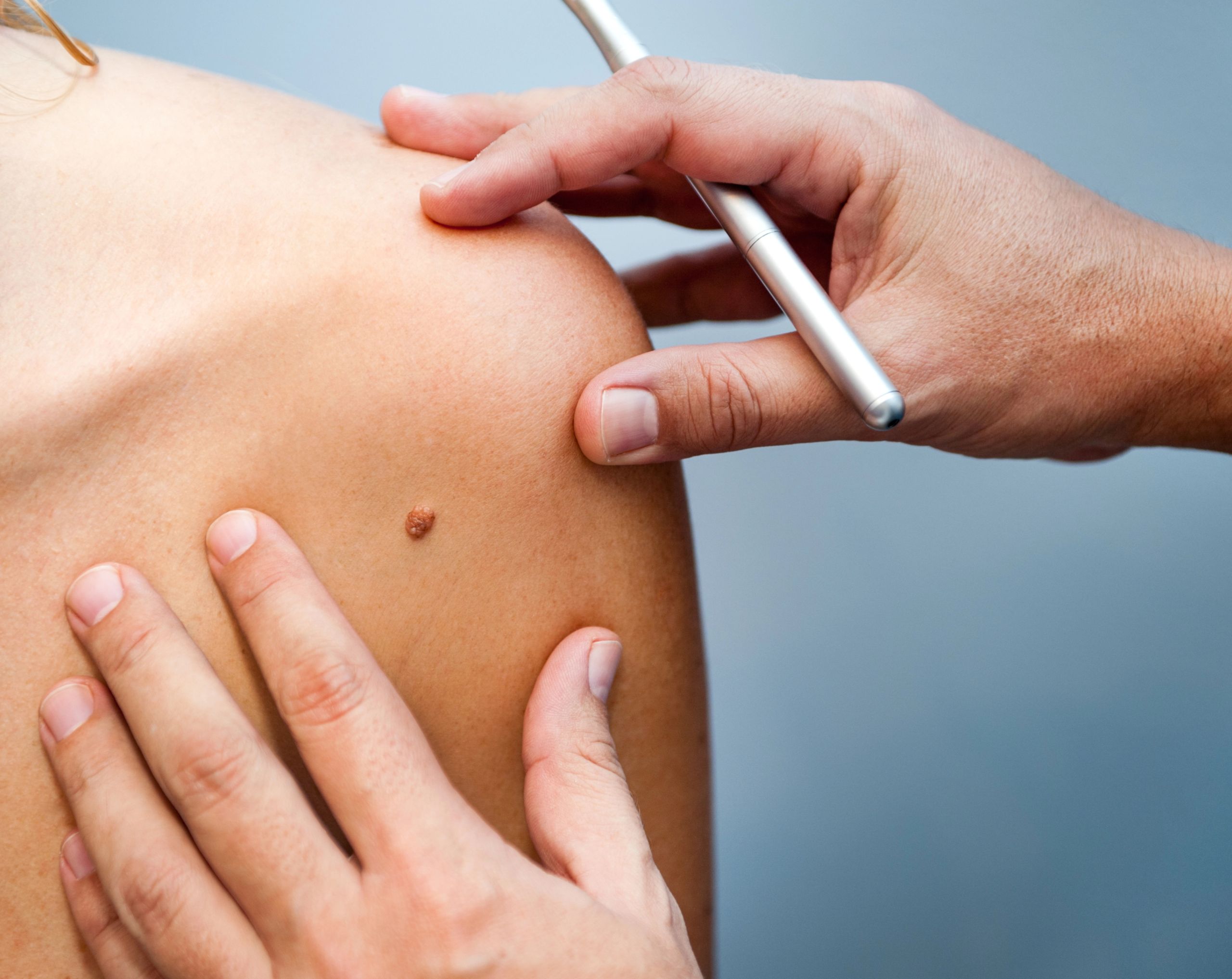 Médico examina el brazo de un paciente para evaluar un bulto sospechoso de carcinoma basocelular o basalioma.