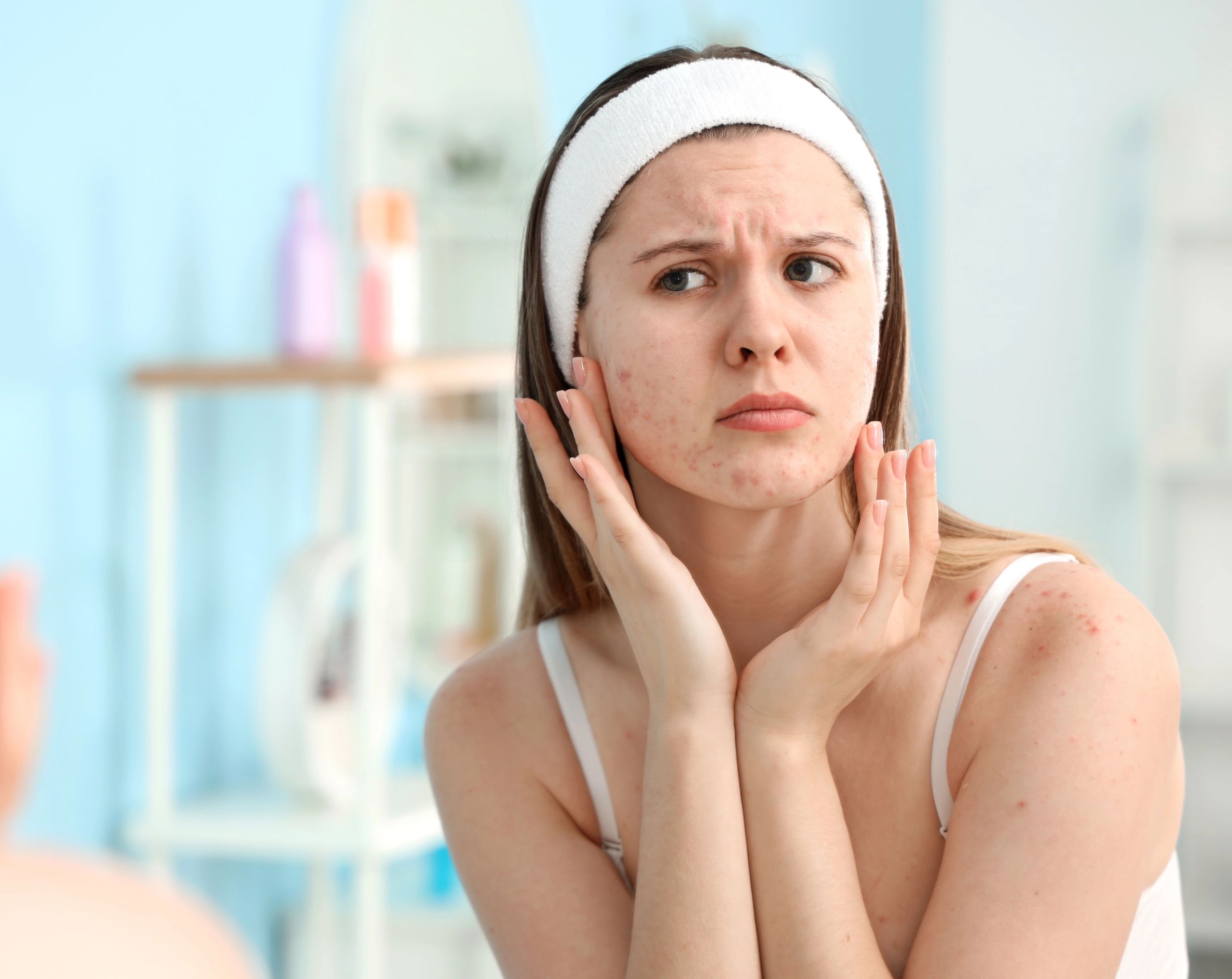 Mujer joven frente al espejo observando los granitos en su rostro provocados por acné hormonal.