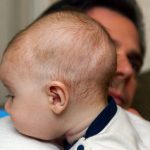 Bebé de pocos meses de edad con dignóstico de craneosinostosis, descansa sobre el hombro de su padre.