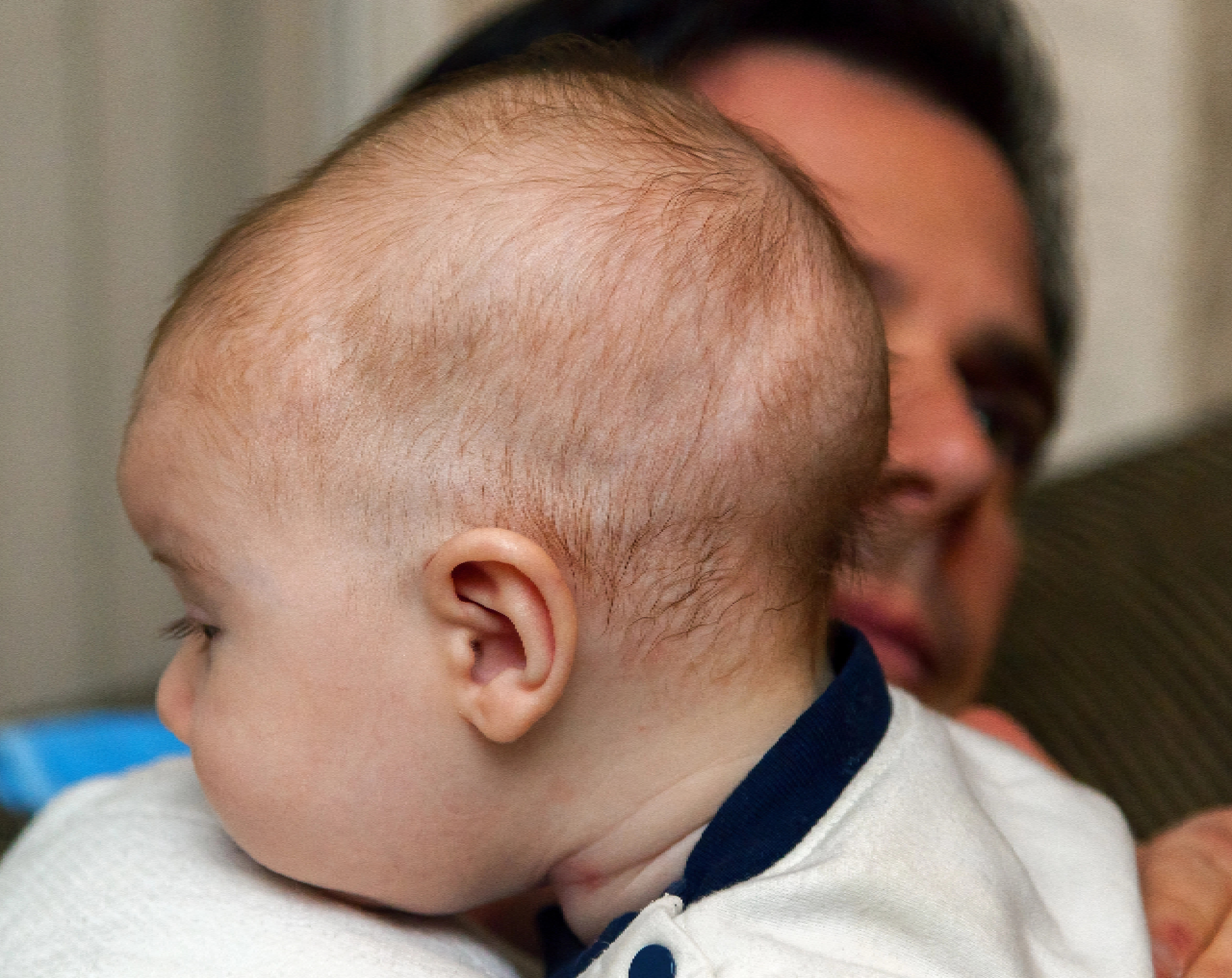 Bebé de pocos meses de edad con dignóstico de craneosinostosis, descansa sobre el hombro de su padre.
