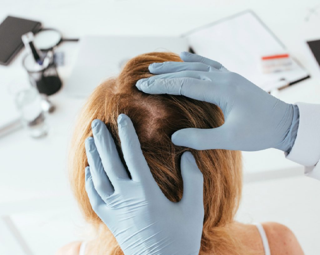 Dermatólogo usa guantes azules para revisar el cuero cabelludo de una paciente en busca de indicios de caspa.