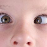 Rostro de un niño pequeño con ambos ojos visibles; uno de ellos desviado hacia adentro, mostrando un caso de estrabismo infantil.