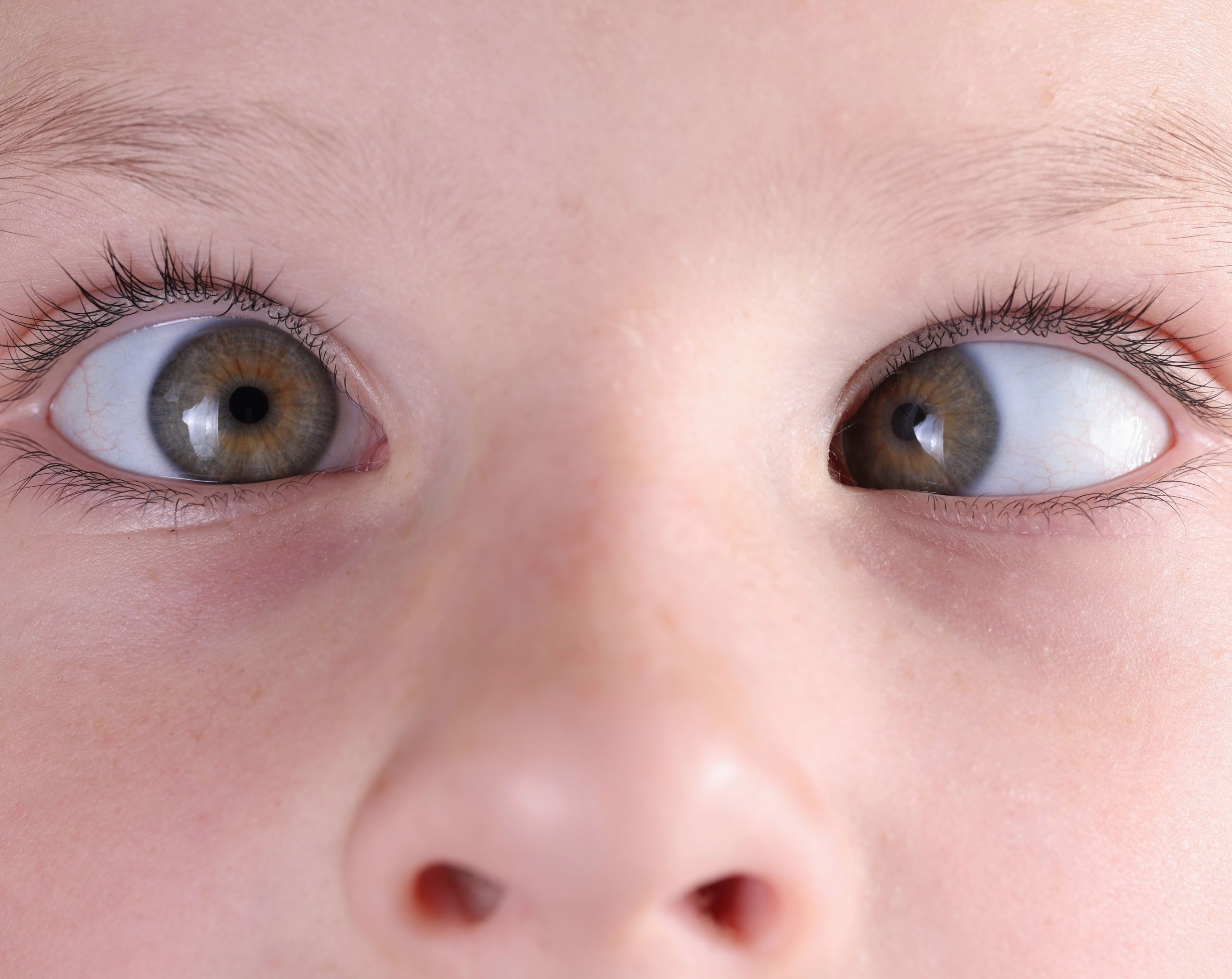 Rostro de un niño pequeño con ambos ojos visibles; uno de ellos desviado hacia adentro, mostrando un caso de estrabismo infantil.