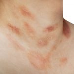 Cuello de una persona joven con erupciones cutáneas rosadas causadas por pitiriasis rosada, mostrando las manchas típicas de esta afección en la piel.