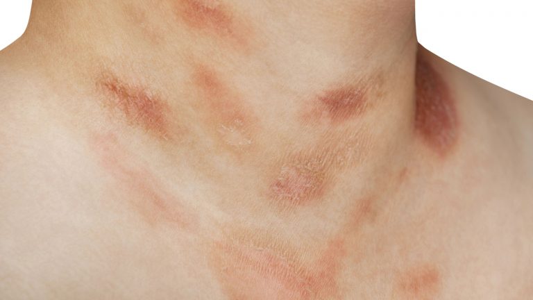 Pitiriasis rosada | ¿Qué es y por qué se da?