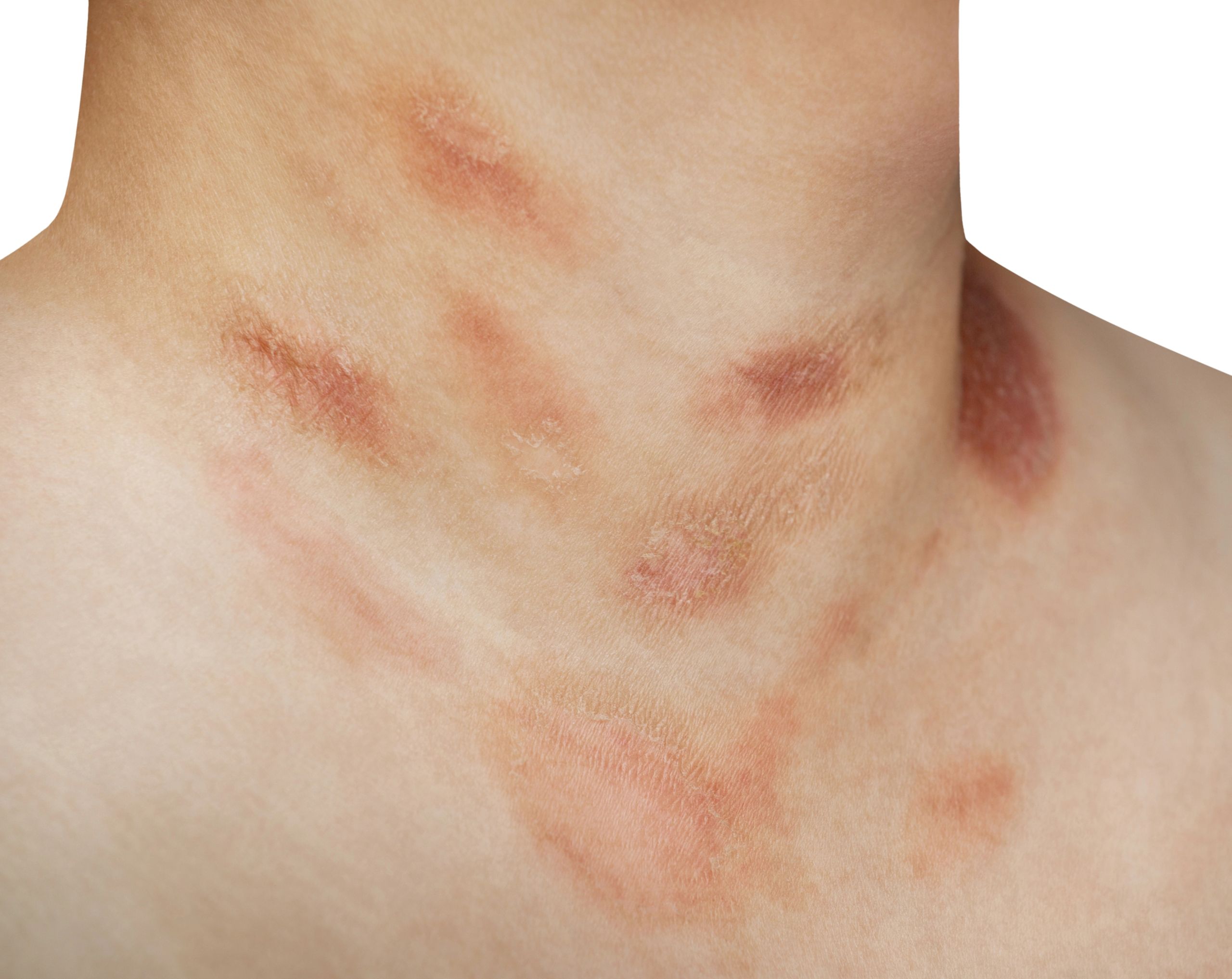 Cuello de una persona joven con erupciones cutáneas rosadas causadas por pitiriasis rosada, mostrando las manchas típicas de esta afección en la piel.