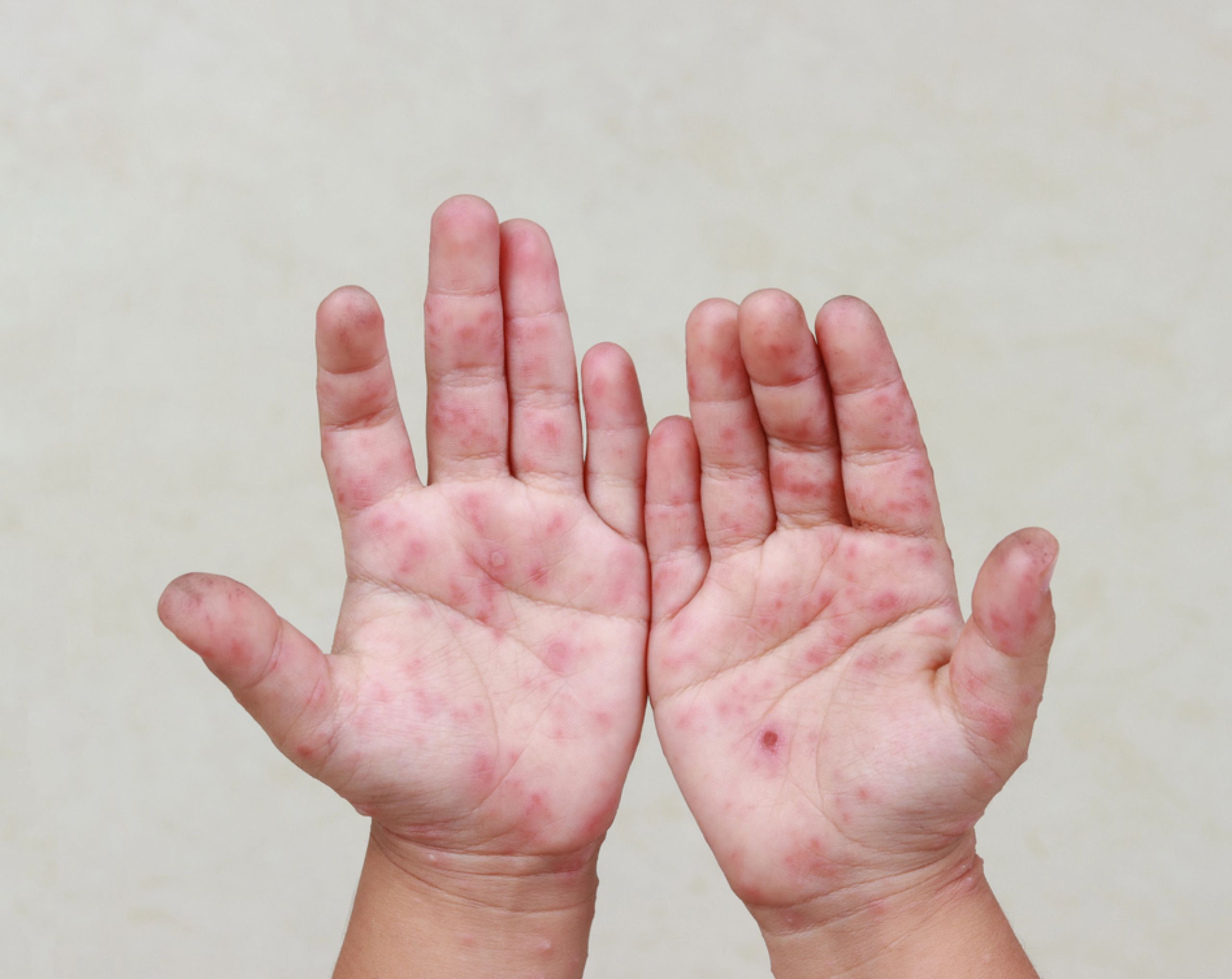 Manos de un niño pequeño con ampollas y erupciones cutáneas, signos característicos de rubéola, mostrando los síntomas visibles de esta enfermedad viral.