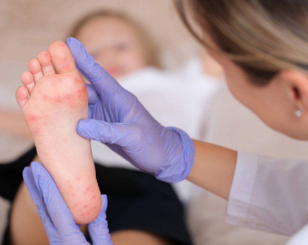 Qué Es El Herpes Se Puede Curar Lo Que Debes Saber