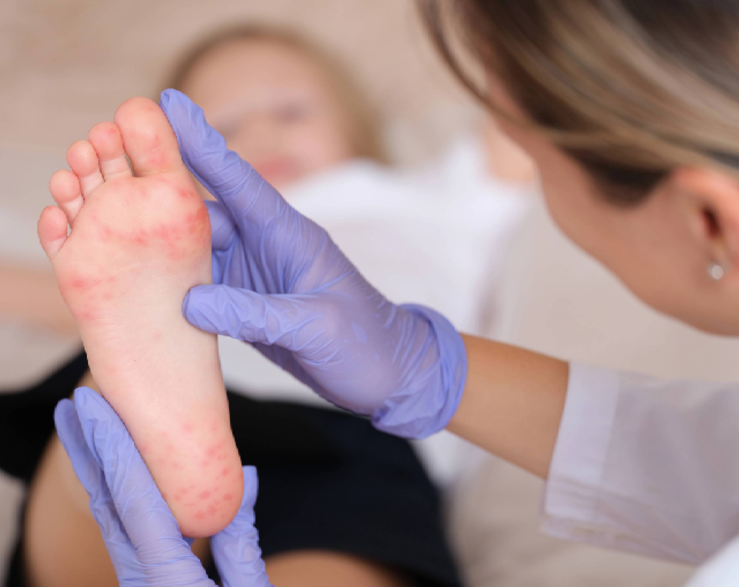 Médico infectólogo pediátrico revisando el pie de un paciente infantil que ha contraido la enfermedad mano pie boca.