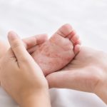 Manos femeninas sosteniendo el pequeño pie de un bebé con erupciones cutáneas causadas por rubéola.