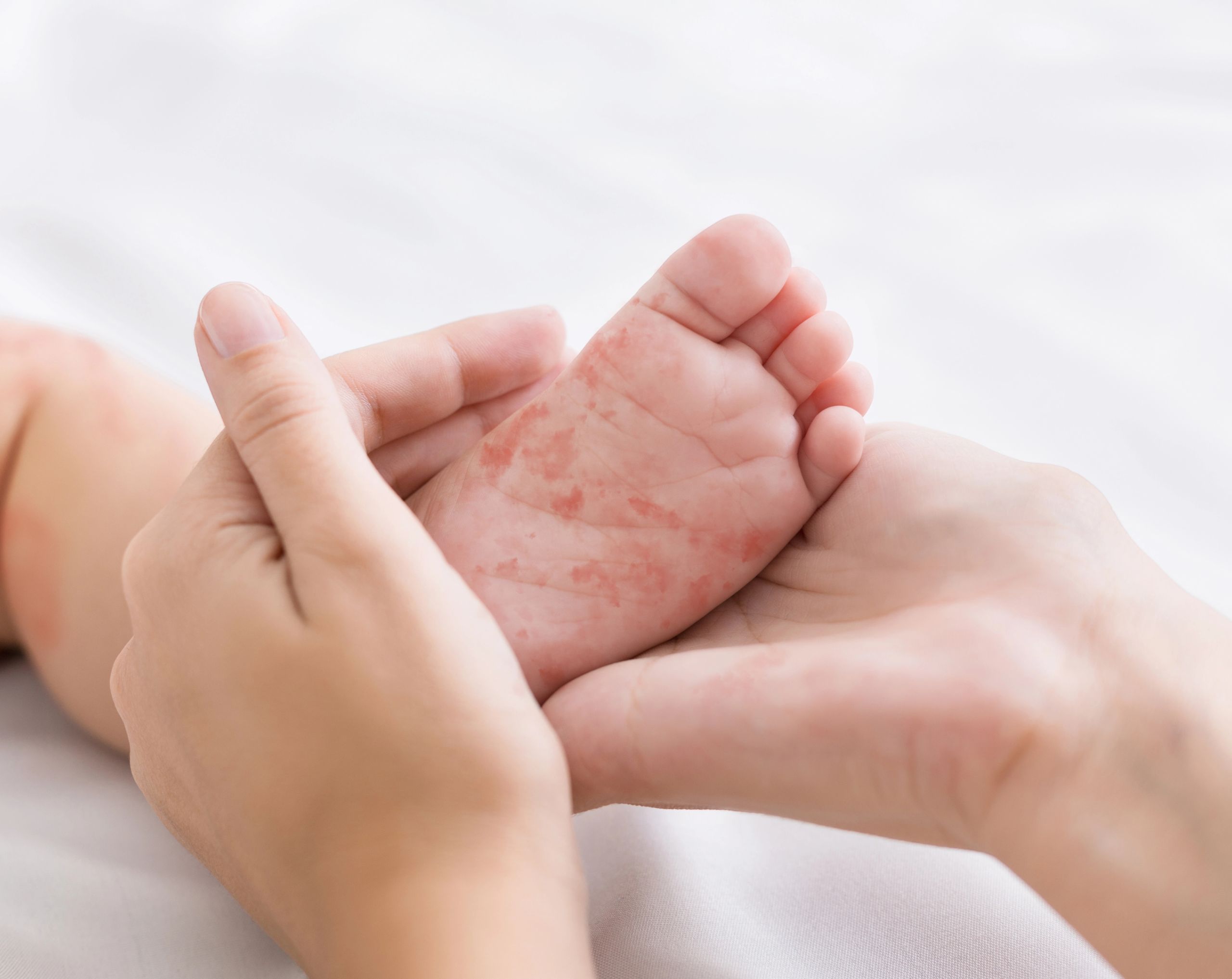 Manos femeninas sosteniendo el pequeño pie de un bebé con erupciones cutáneas causadas por rubéola.