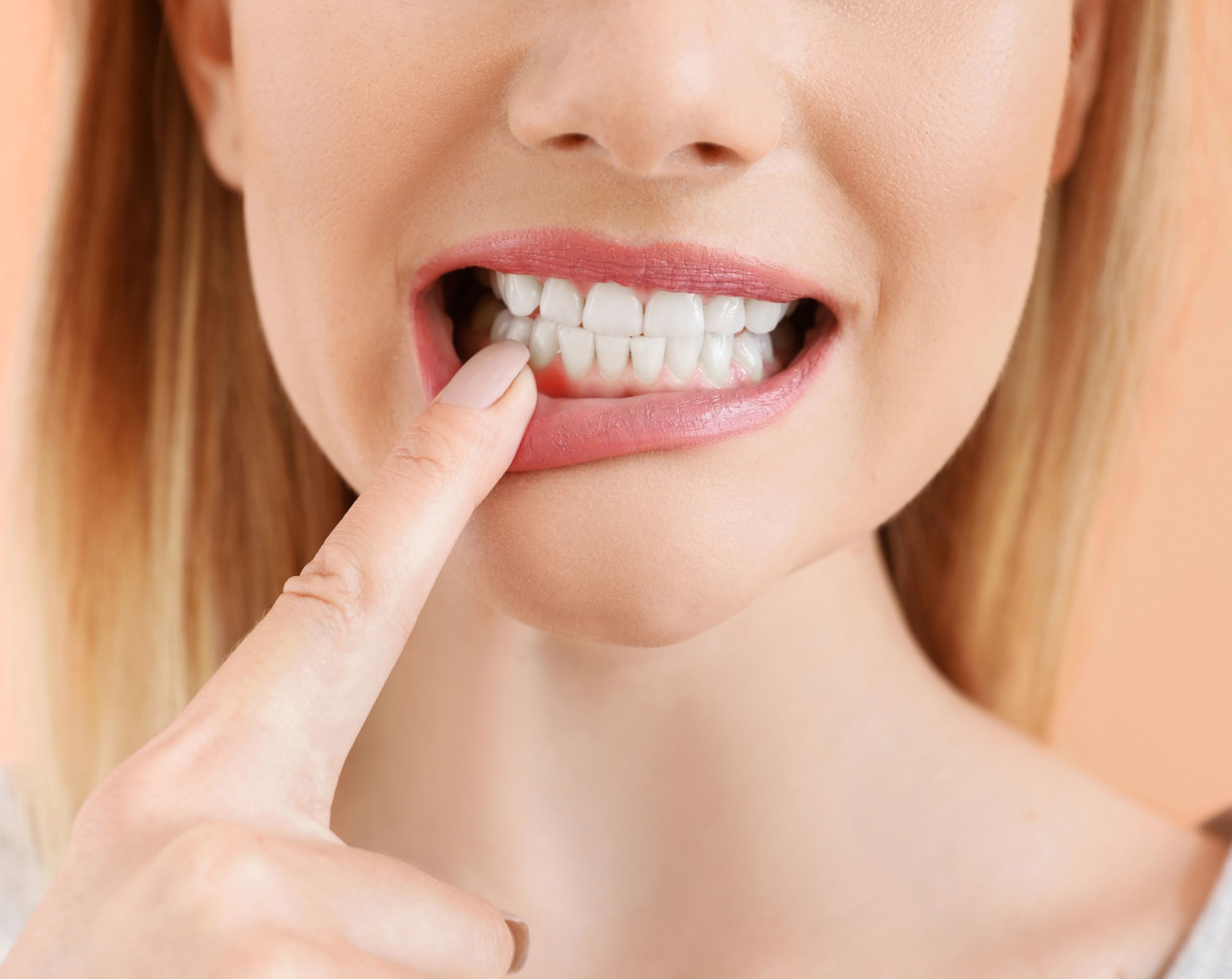 Mujer de mediana edad toca con el dedo índice sus encías inflamadas a causa de un absceso dental, mostrando hinchazón y molestia en la zona bucal