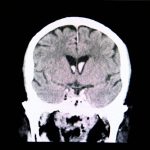 Radiografía del cerebro de un paciente que requiere craneotomía.