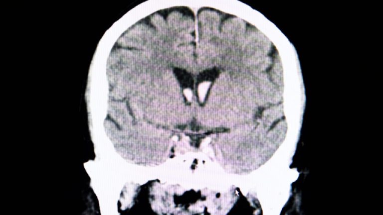 Craneotomía | ¿En qué consiste?