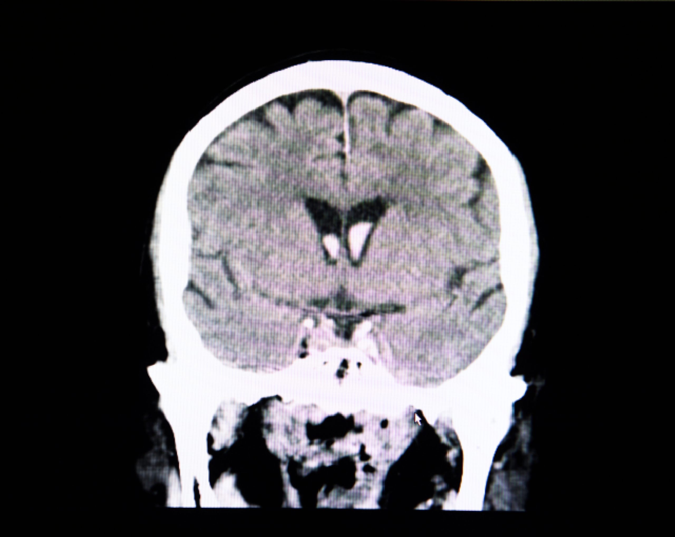 Radiografía del cerebro de un paciente que requiere craneotomía.