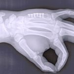 Radiografía que muestra una mano con una placa de osteosíntesis para ayudar a sanar una fractura.