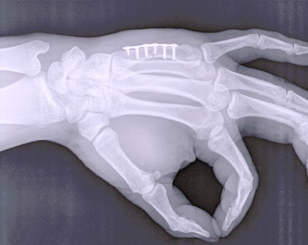 Osteosíntesis | ¿Qué es y cómo ayuda a tus huesos?