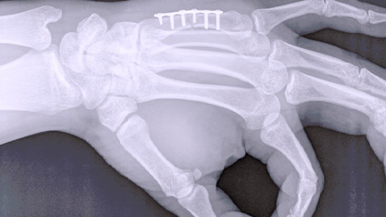 Osteosíntesis | ¿Qué es y cómo ayuda a tus huesos?
