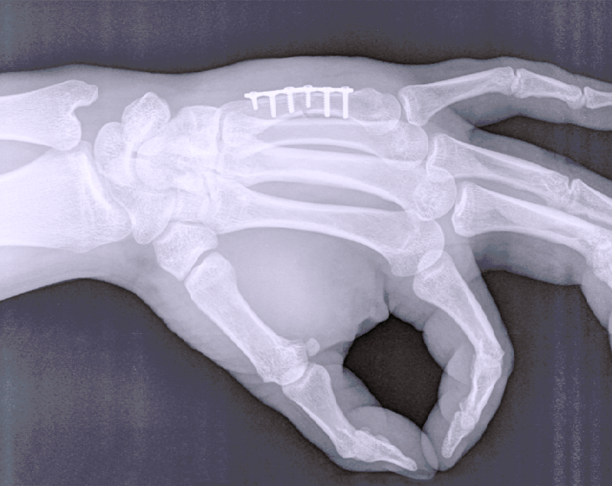 Radiografía que muestra una mano con una placa de osteosíntesis para ayudar a sanar una fractura.