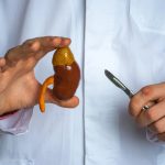 Médico sostiene en una mano un modelo anatómico 3D de un riñón y en la otra un bisturí, haciendo referencia a una nefrectomía.