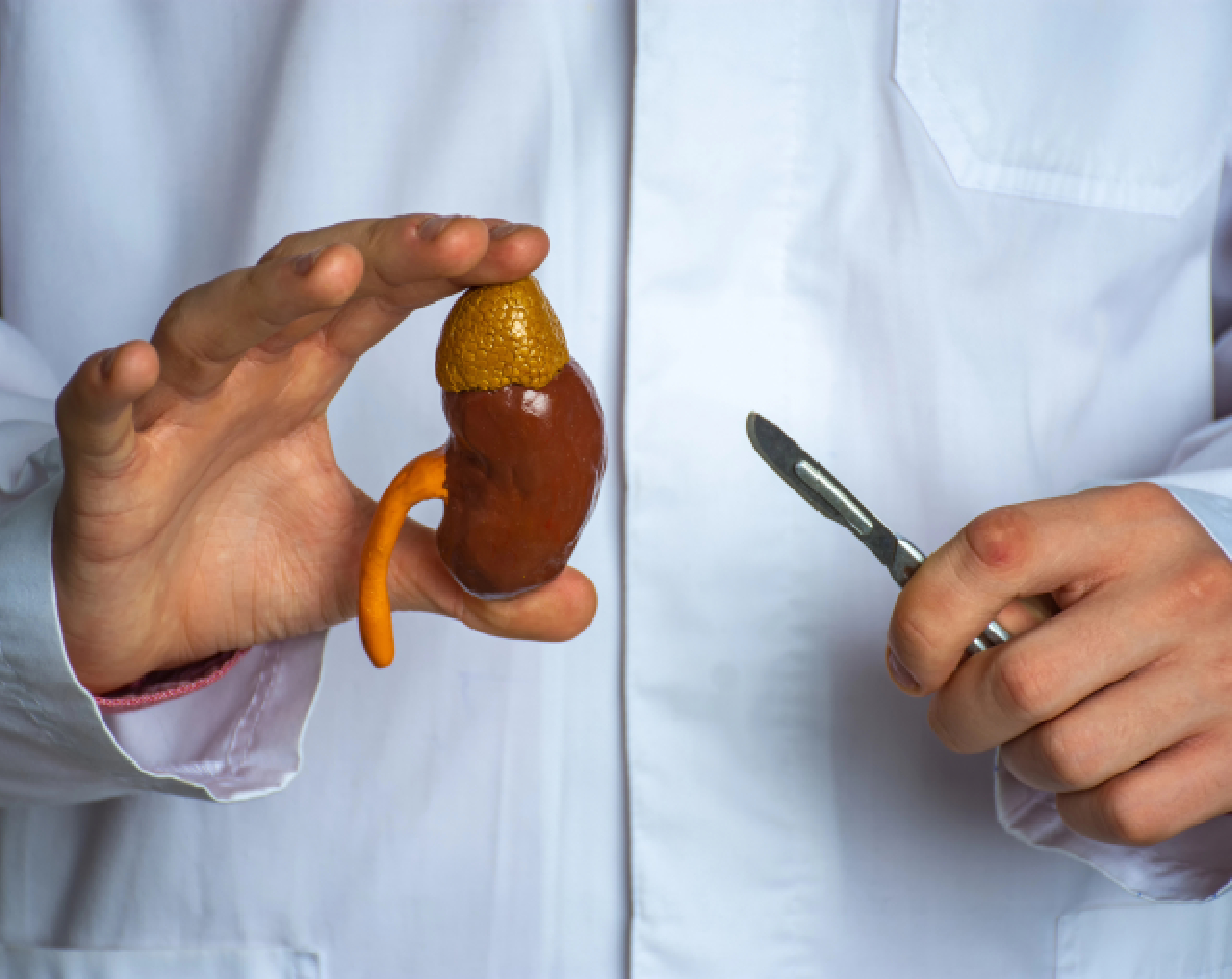 Médico sostiene en una mano un modelo anatómico 3D de un riñón y en la otra un bisturí, haciendo referencia a una nefrectomía.