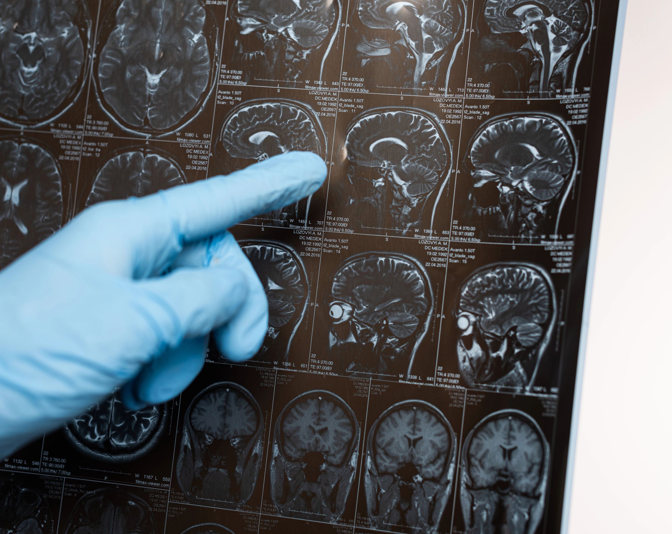 Neurólogo examina con la mano una tomografía de paciente que presenta hemorragia subaracnoidea. 