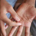 Mujer joven examinando ampollas en la palma de la mano, un síntoma característico de la dishidrosis.