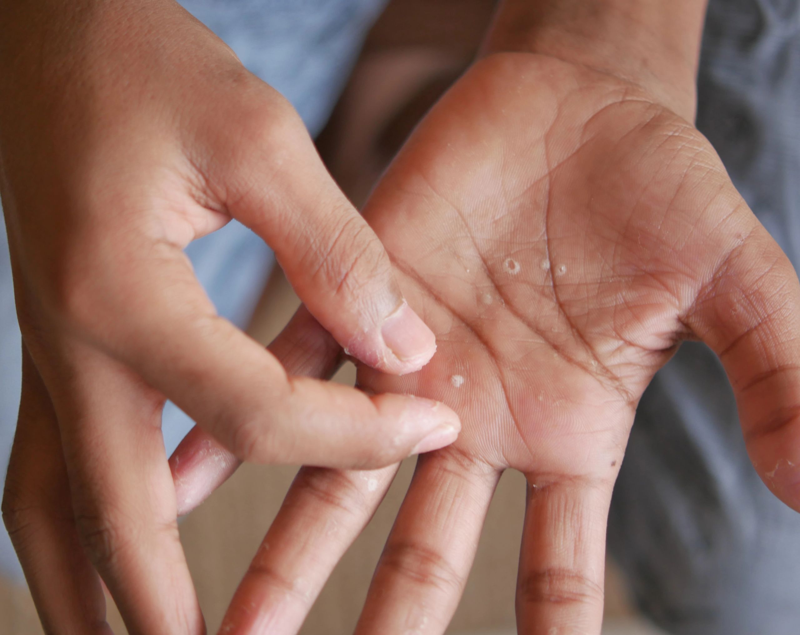 Mujer joven examinando ampollas en la palma de la mano, un síntoma característico de la dishidrosis.