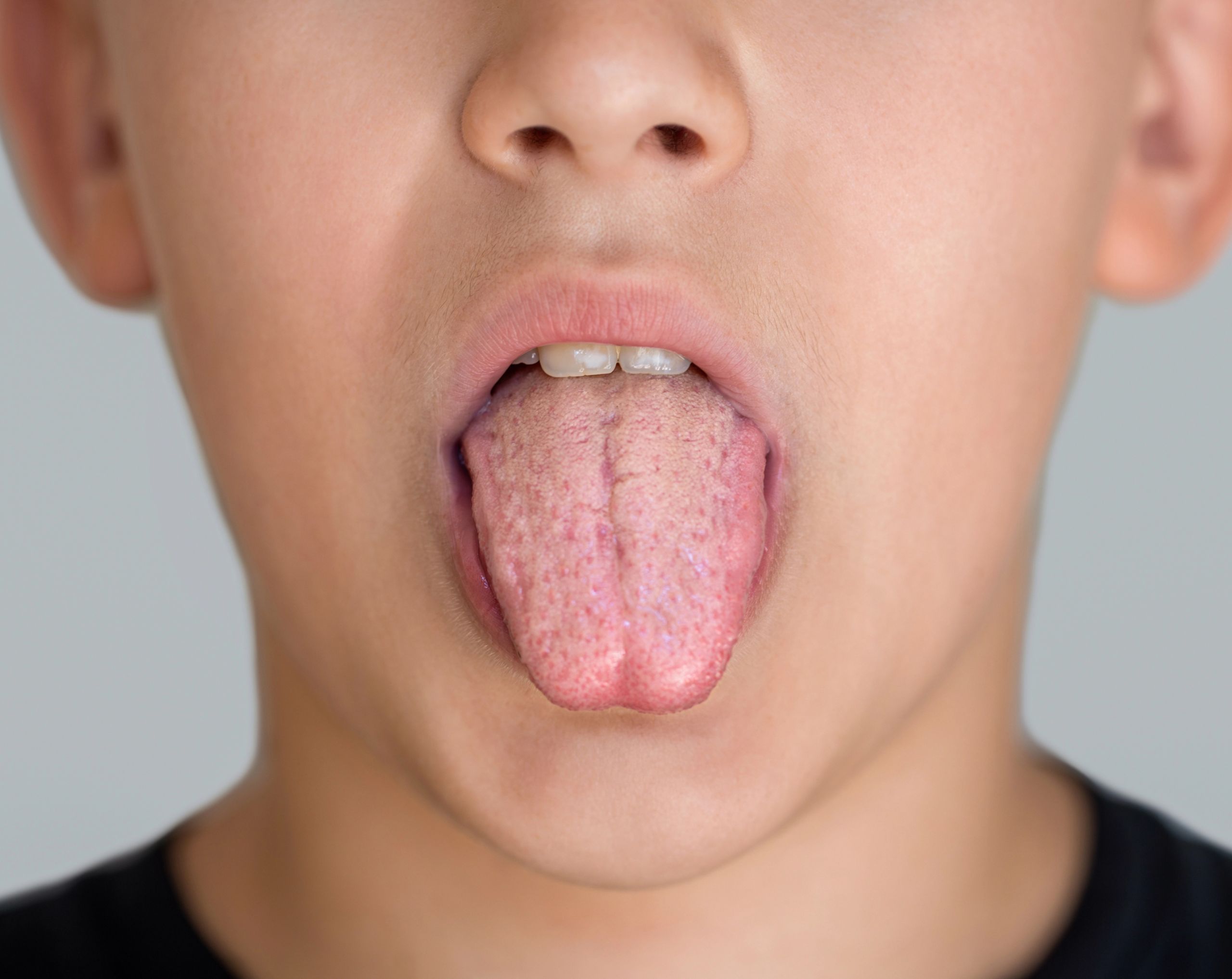 Niño mostrando la lengua con manchas blancas visibles, síntoma de algodoncillo. 
