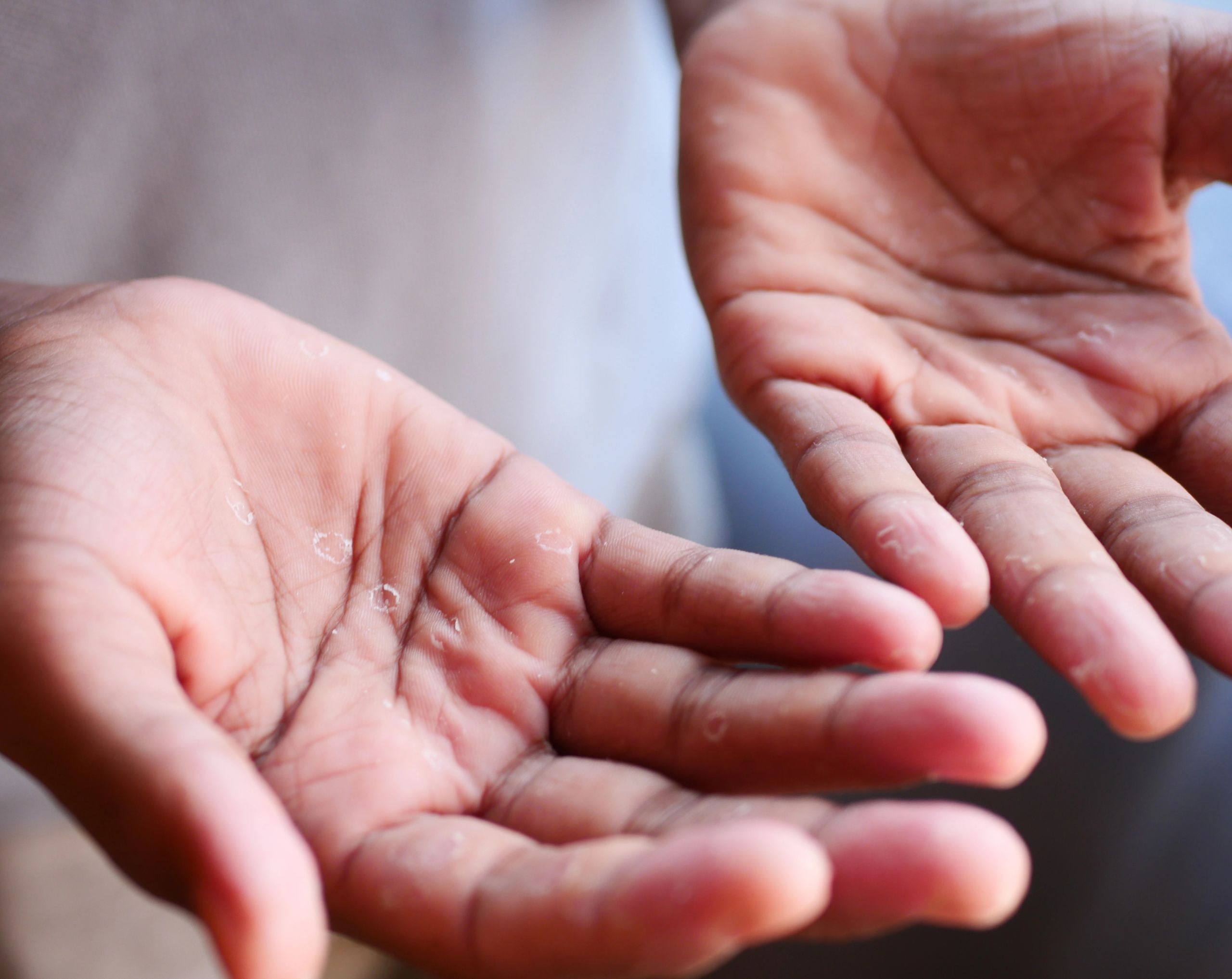 Manos de un hombre joven con ampollas en las palmas, un síntoma común de la dishidrosis.