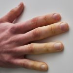 Mano de hombre con cambios de coloración en los dedos por frío (fenómeno de Raynaud), asociado a esclerodermia.