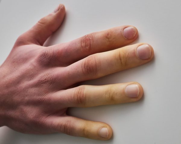 Esclerodermia: ¿qué es y cuáles son sus síntomas?