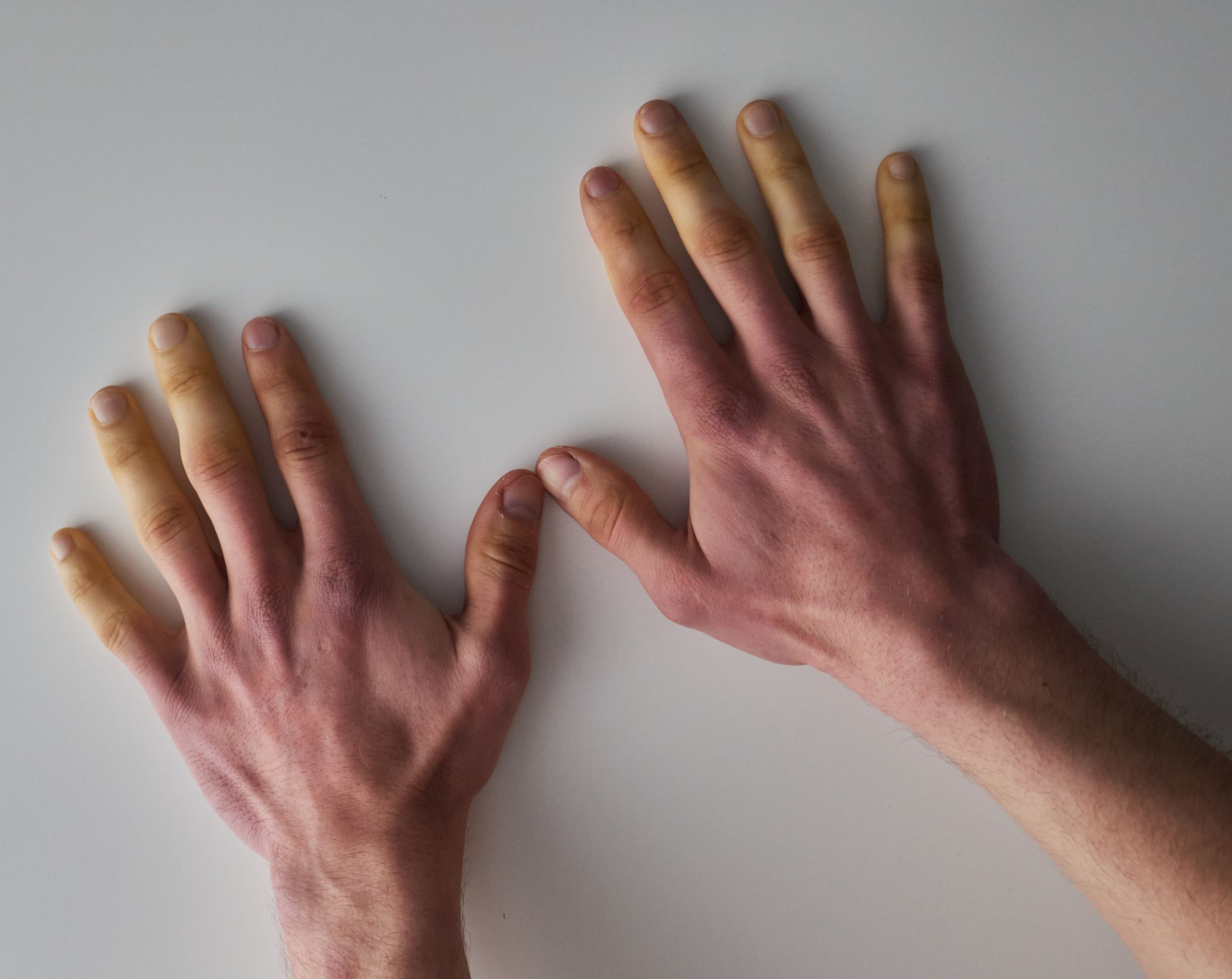 Manos extendidas sobre una mesa blanca con los dedos blanquecinos por exposición al frío, signo asociado a esclerodermia.