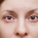 Mujer joven mirando a la cámara con una perrilla (orzuelo) visible en el párpado inferior.