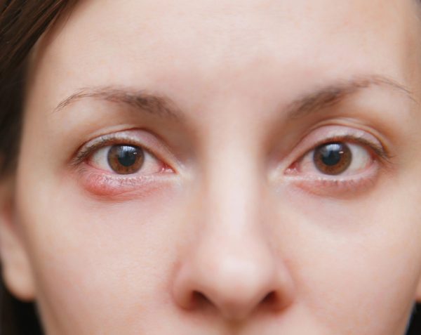 Perrilla | Causas, síntomas y tratamiento