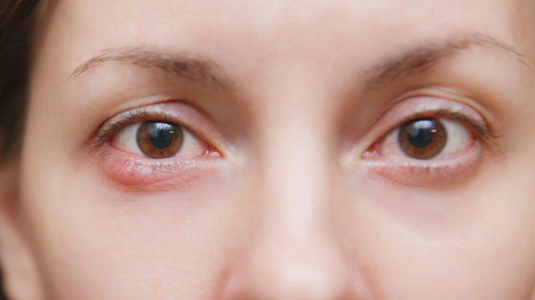 Perrilla | Causas, síntomas y tratamiento