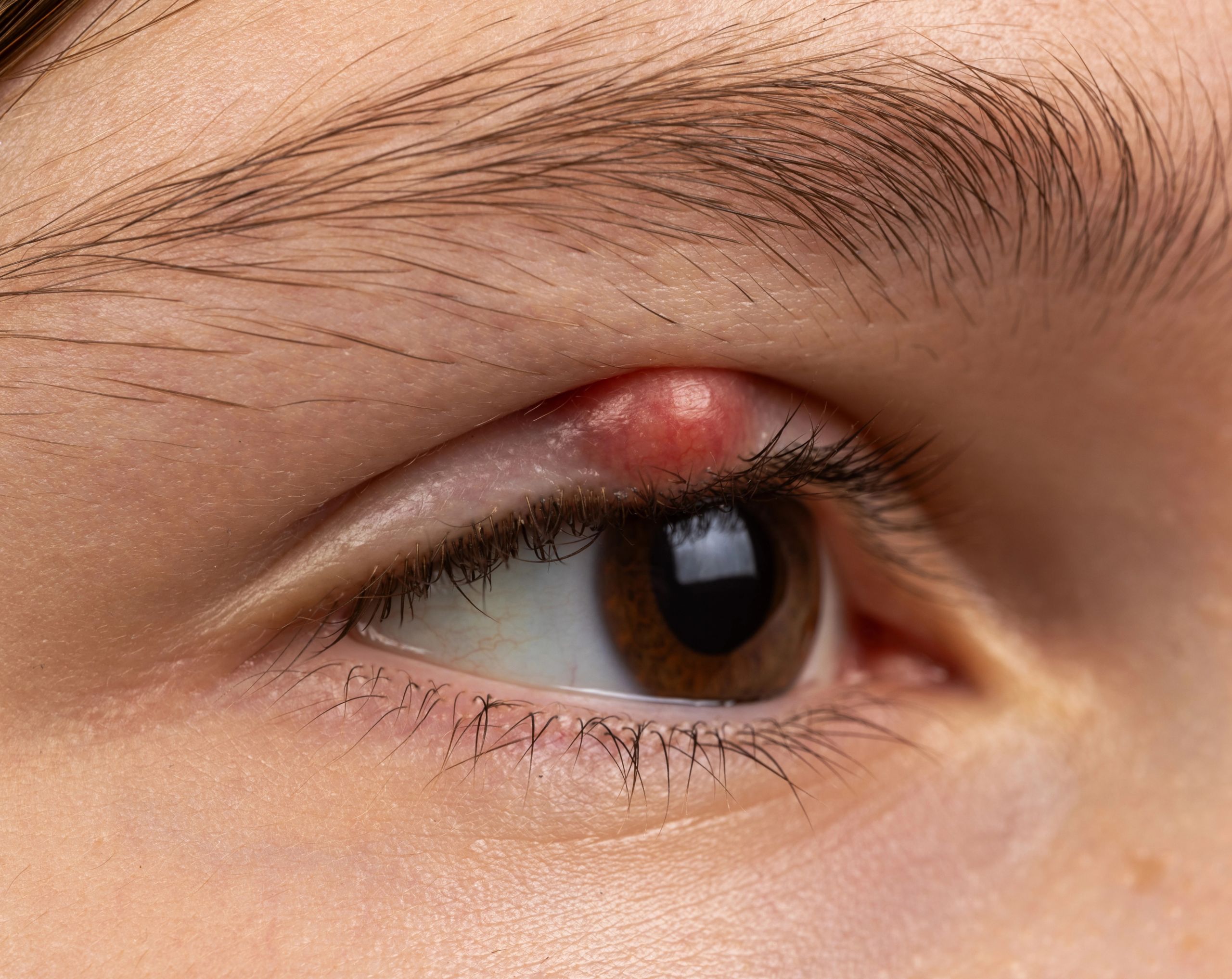 Vista lateral del ojo derecho de una niña con chalazión visible en el párpado superior.