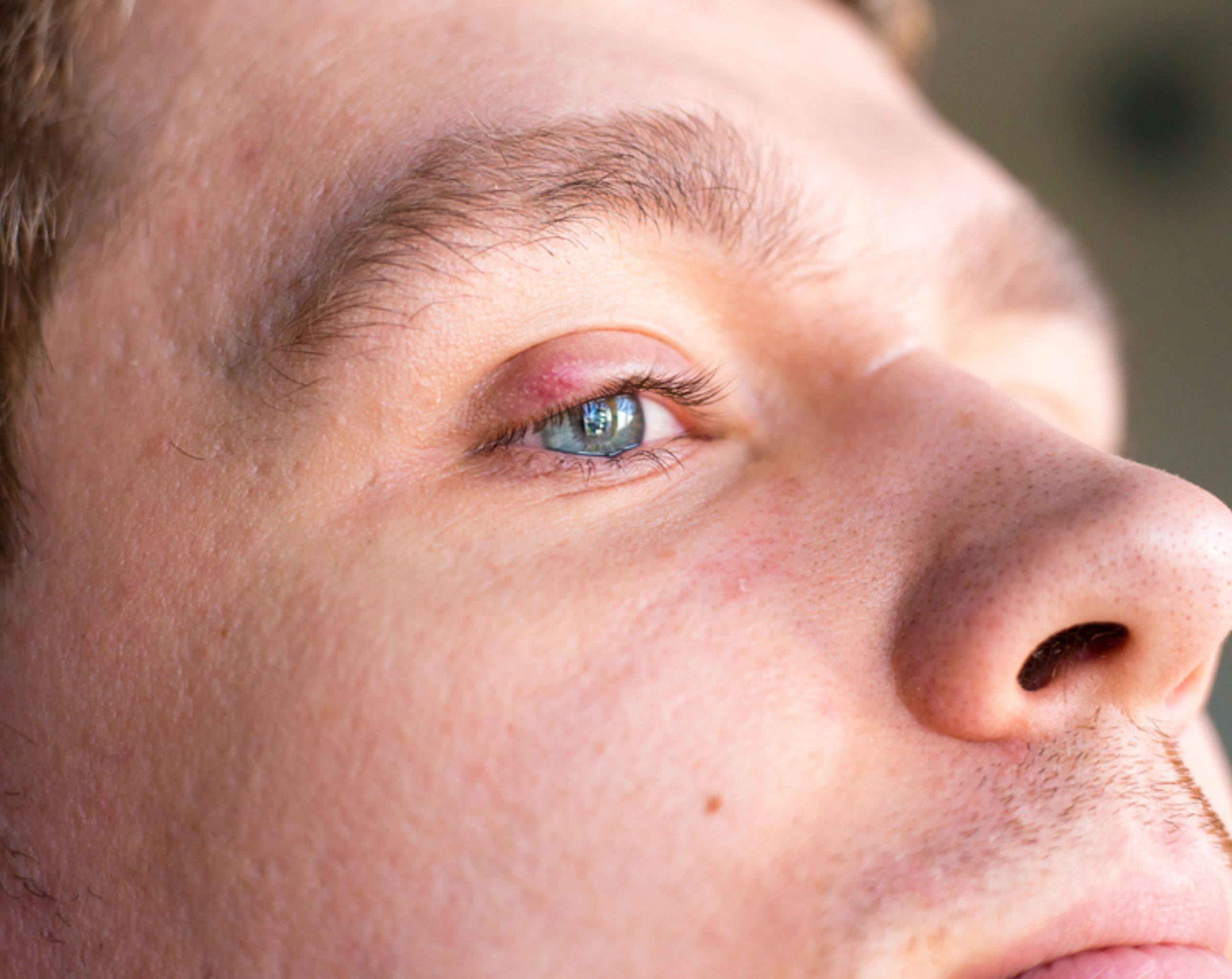Hombre con la mirada fija y una perrilla visible en el párpado superior.