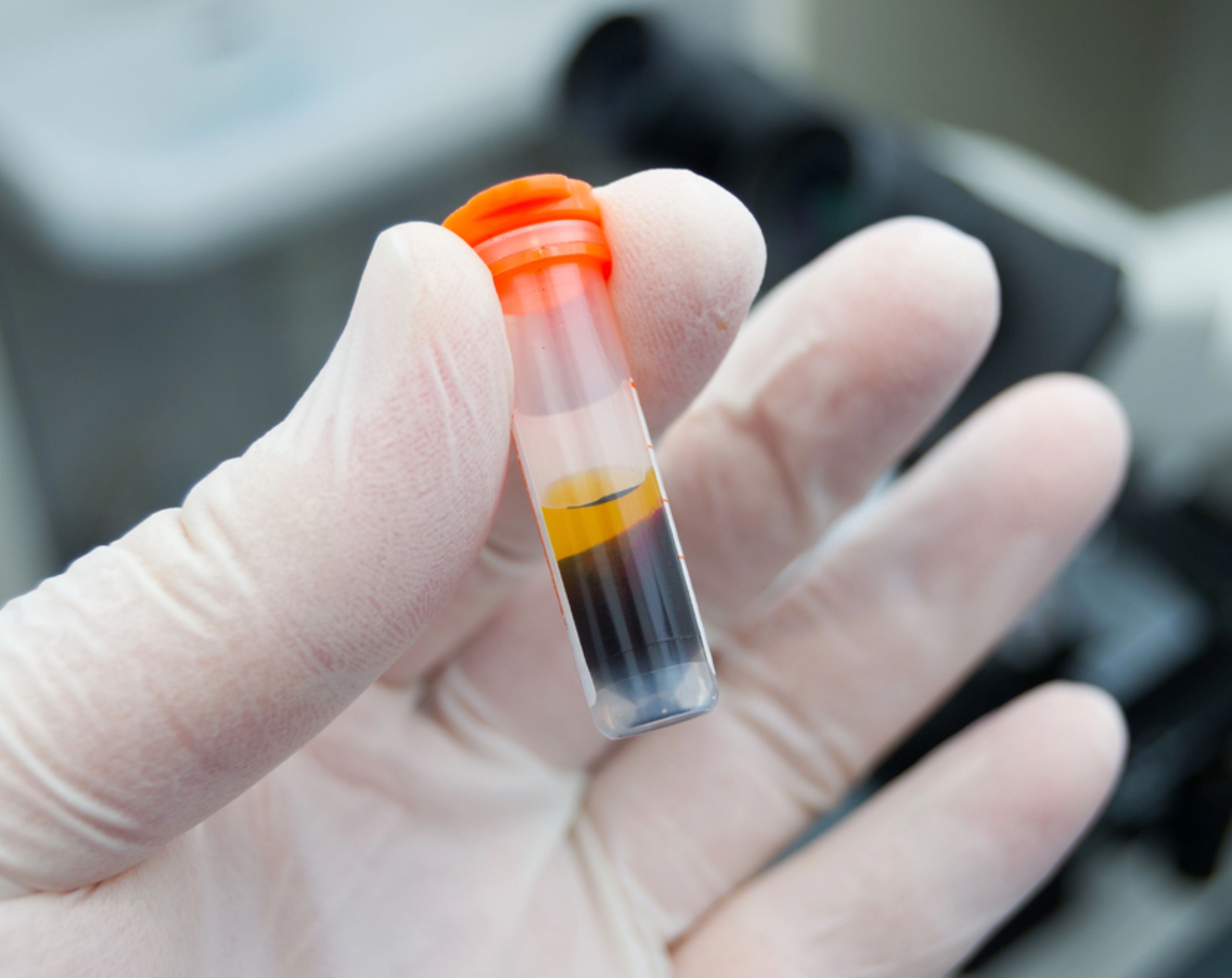  Laboratorista con guantes sostiene un tubo de ensayo con una muestra de sangre separada en plasma y componentes sanguíneos. 