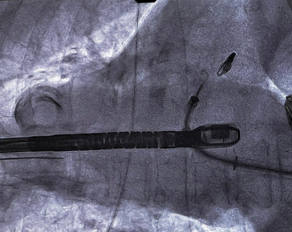 Imagen en pantalla de la sala de hemodinamia de la colocación de MitraClip a un paciente con insuficiencia mitral, en Hospital Angeles Morelia.